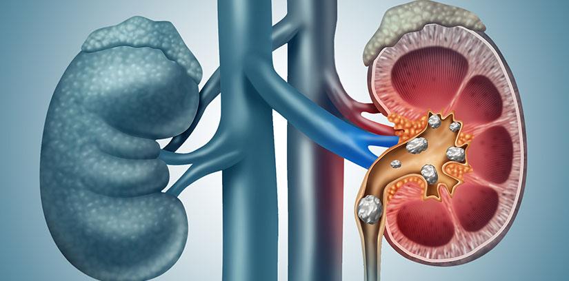 Kidney & Gallbladder Stones